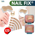 NailFix® Olvídate de sufrir de uñas encarnadas