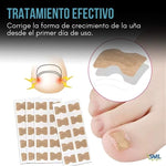 NailFix® Olvídate de sufrir de uñas encarnadas
