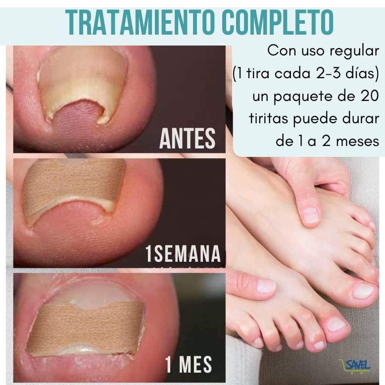 NailFix® Olvídate de sufrir de uñas encarnadas