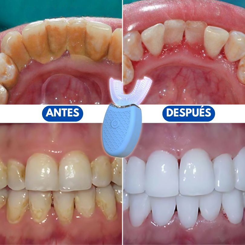 SmartClean U-Pro®: La mejor limpieza dental en solo 30 segundos